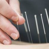 Dry Needling